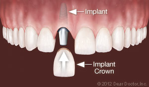 Dental Implants Replace One Tooth.